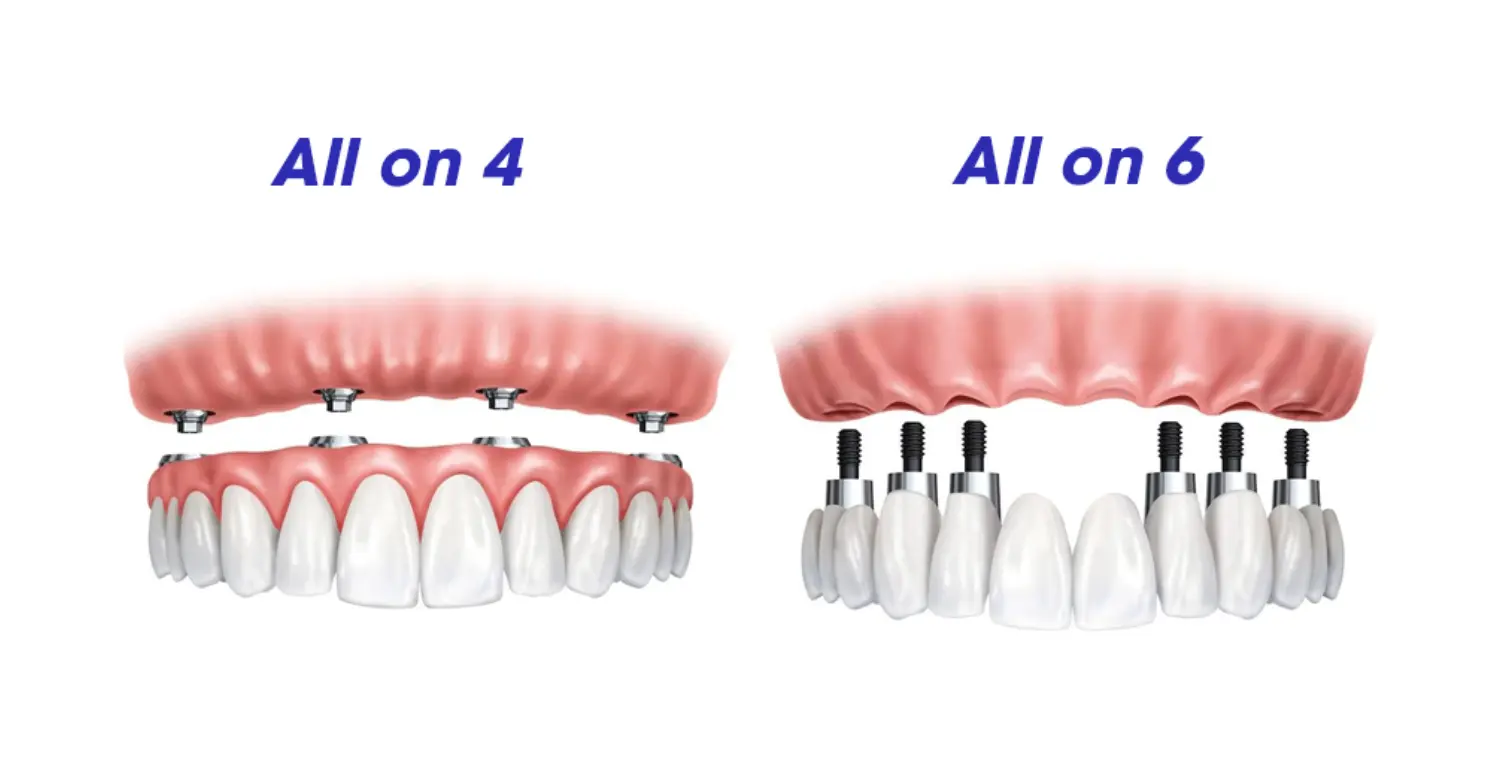 All on 4 vs All on 6 Dental Implants 2